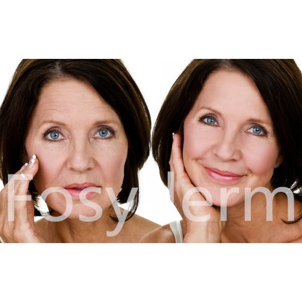 Sterile 2ml Derm Pure Dermal Filler Hyaluronic Acid Injections For Wrinkles