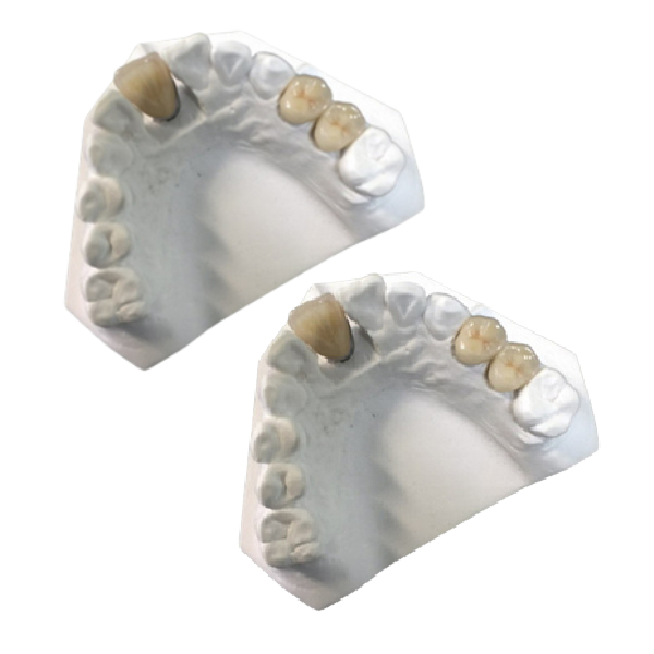 Yellow Gold Porcelain Dental Crown OEM High Strength New Condition