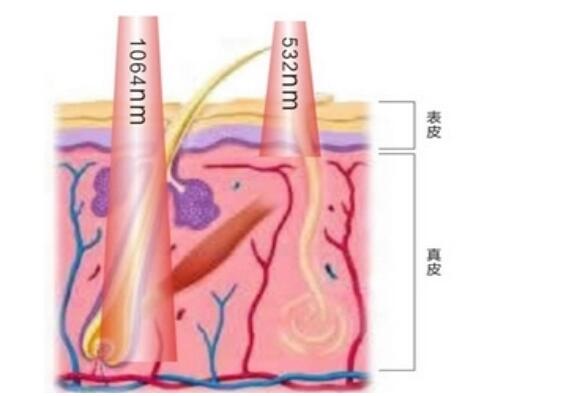 Multifunctional Tattoo Laser Removal Equipment With 1064 nm 532 nm Black Ball Tip