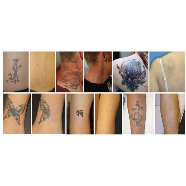 7mm Diameter Laser Rod Handheld Tattoo Removal Nd Yag Laser Handpiece