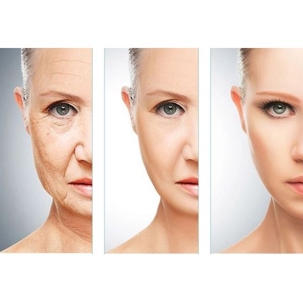 1 do instante profundo do enchimento de X 1.1ML Rejeunesse CE profundo ácido hialurónico do enchimento do enrugamento