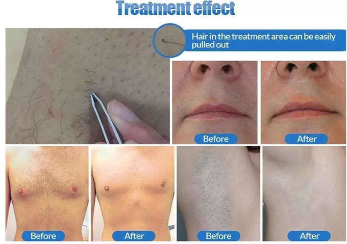 машина удаления волос лазера диода платины 808 льда сопрано лазера 1200W Альма