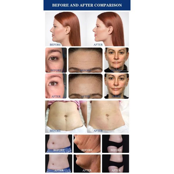 Vacuum Roller Lipo Massager RF Vacuum Infrared Cellulite Reduction Equipment