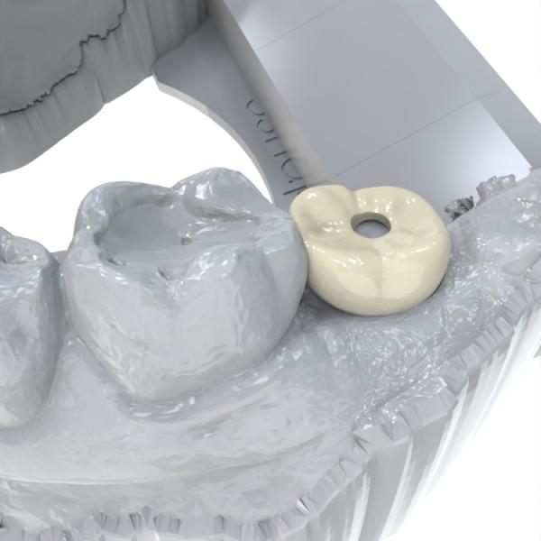 Dental Crown Restoration Permanent Crown Resin For Dental Crowns Volume 1000 Ml