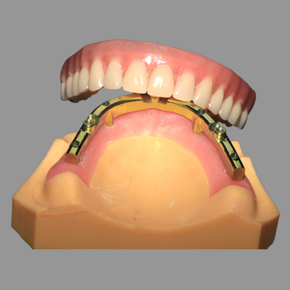 Lmplant Dental Laboratory | Full Acrylic Denture All On X Dental Lmplants AOX Class 4 With Locator Attachment