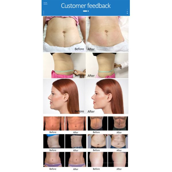 Maquina estetica profesional celulitis 360 productos de belleza equipo estetica para salon de belleza