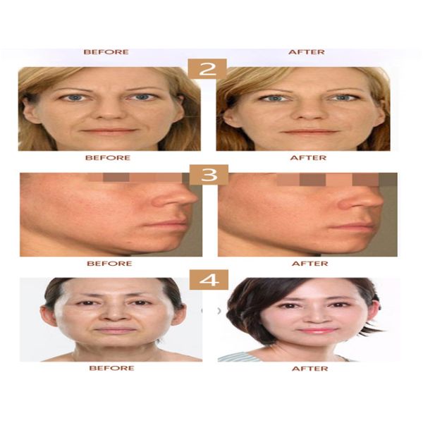 Клиника красоты Пополнители для кожи Стимулятор коллагена для щек Противовозрастные