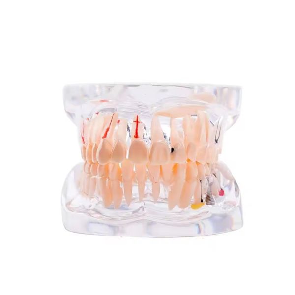 32 Tooth Full Month Implant Disease Teeth Model Clear Design  Dental Pathology Model