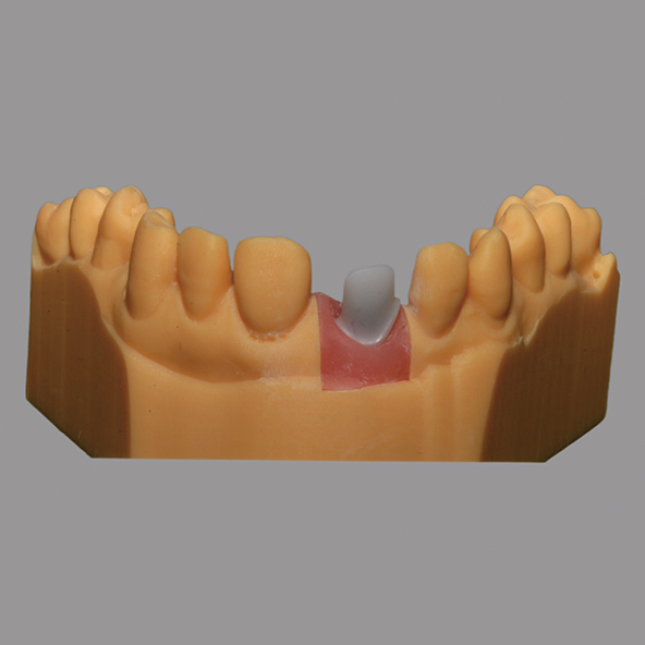 White Custom Zirconia Abutment Natural Looking For Dental Restoration