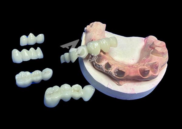 Une couronne de zirconium de lave d'apparence naturelle avec une durabilité inégalée