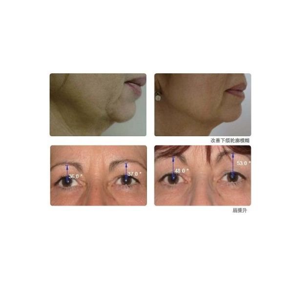 Deep Blue RF Beauty Equipment System for Body Slimming & Skin Tighten