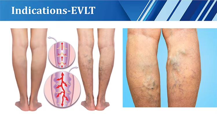 Evlt Phlebology Endovenous Laser 1940nm Fiber Veins Laser Machine