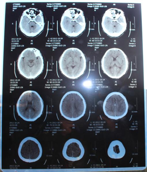 Thermal/Inkjet x ray ct scan Film Thermal dry printer Manufacture Medical film base blue sensitive medical dry film