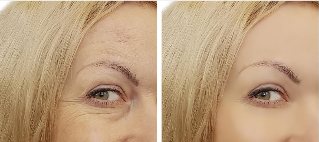 Блок токсина 100 дермального заполнителя  Hyaluronic кисловочный Botulinum напечатать анти- морщинку
