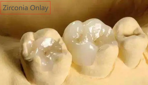 Zirconia Crown