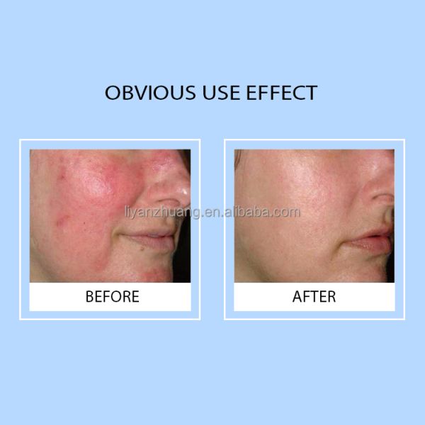 Lyz Custom Anti-Aging Moisturizing Repair Freeze-Dried Set Hyaluronic Acid Infused Copper Peptides Serum for Face Home Spa Use