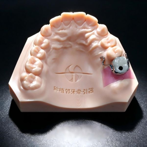 Traction Appliance for Adjacent Teeth Prior to Implant Placement