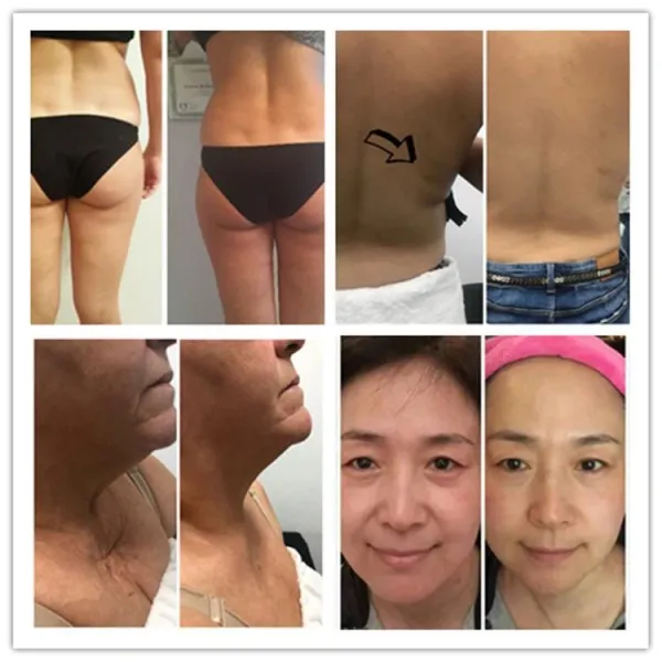 Body Weight Loss Lipo Laser Treatment Fat Removal Machine For Slimming