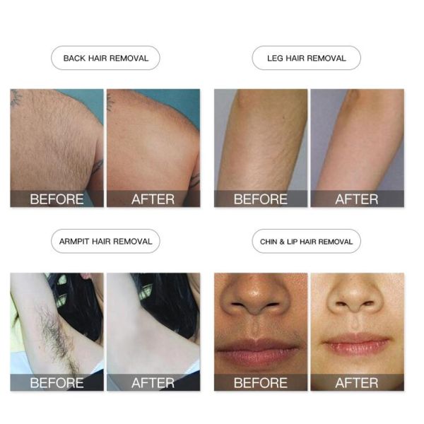 Triple Wavelength Diode Laser Hair Removal Machine 755 808 1064nm Available