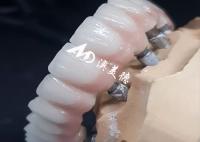 Des implants dentaires de haute performance exclusifs