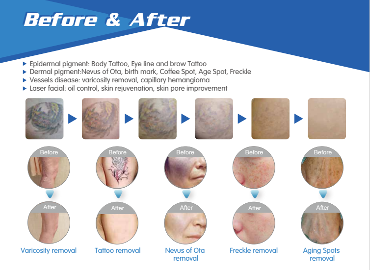 last 4 days for whole year biggest promotion activity multifunctional nd yag laser machine