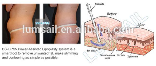 Power Assisted Liposuction Machine Intervention therapy fat suction