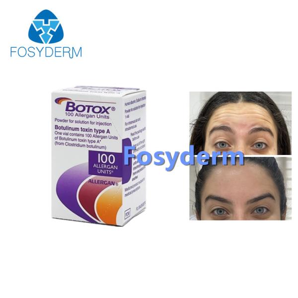 100Units Allergan Toxion Botulinum para removem o tipo facial A de Botox dos enrugamentos