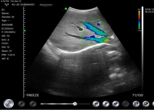 Home Doppler Ultrasound Portable Diagnostic Hand held Doppler Ultrasound Obstetric Gynecology Pediatrics Application