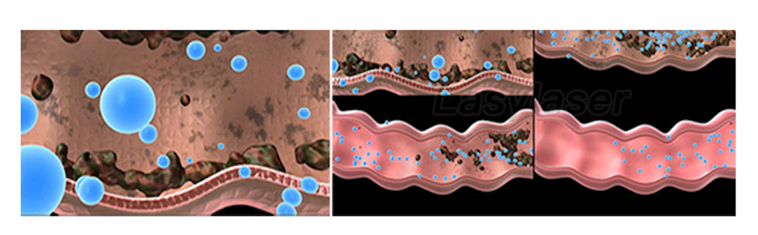 Irrigation 2L / Min Colon Therapy Machine Supersonic