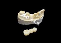 Coroa dentária de zircônio estética de alta dureza com translucidez e resistência à ruptura do laboratório dentário da China