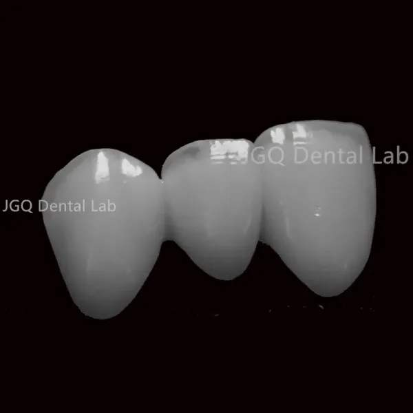 Customized Dental Crown and Bridge Porcelain Fused to Zirconia with CE FDA Certification and 3D Laser Printing