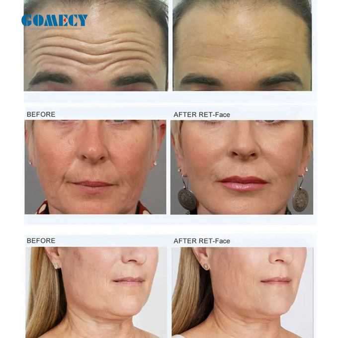 Мускульный стимулятор Mffface EMS для лифтинга лица Лифтинга шеи Лифтинга кожи Лифтинга и затягивания