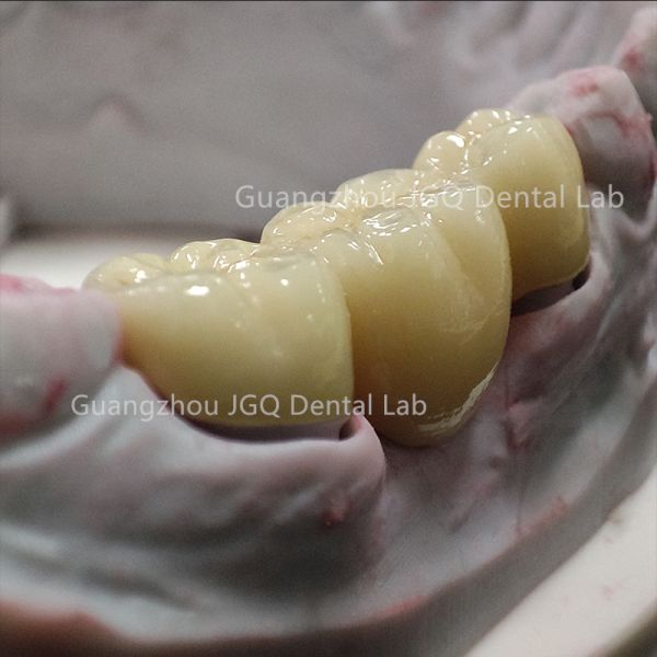 High Fracture Resistant Zirconia Crown Bridge CNC For Bruxism Heavy Occlusion