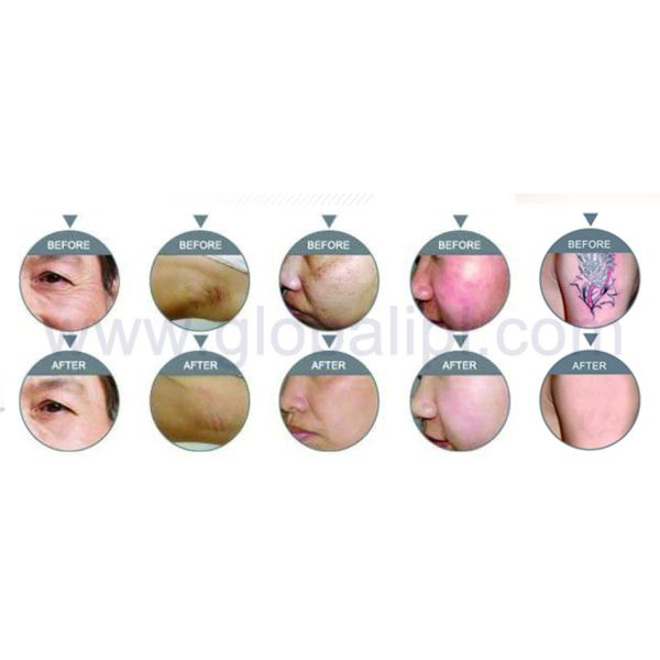 Multifunction IPL RF Beauty Equipment Hair Removal Wrinkle Removal Machine