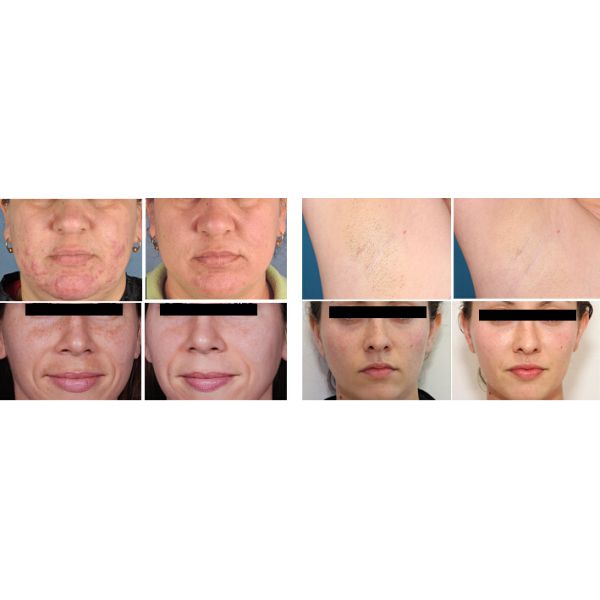 SHR / IPL Laser Machine Temperature Alarm Safety Control For Fast Hair Removal