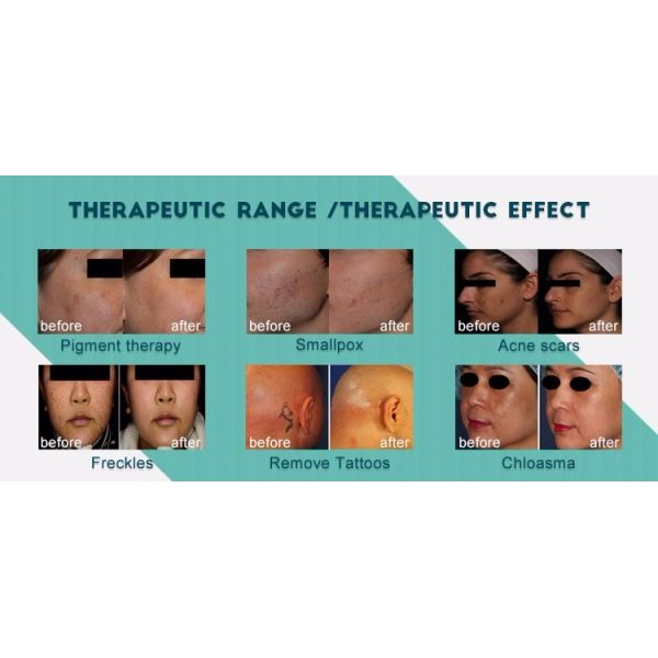 1064nm 532nm 755nm Nd Yag Laser Tattoo Removal Machine With Korea Treatment Head