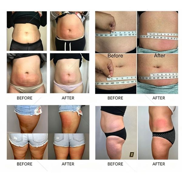 360°Cryolipolysis Slimming Machine , Fat Freezer Cryolipolysis System