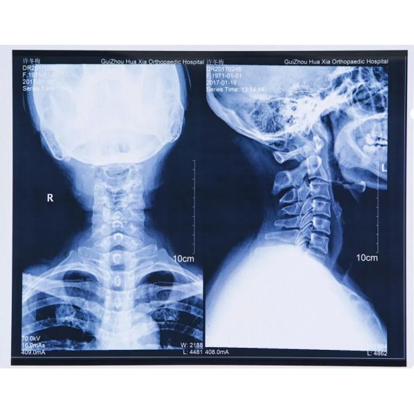 Синий лазерный медицинский сухой сексуальный рентгеновский Bf пленка для рентгеновского обследования