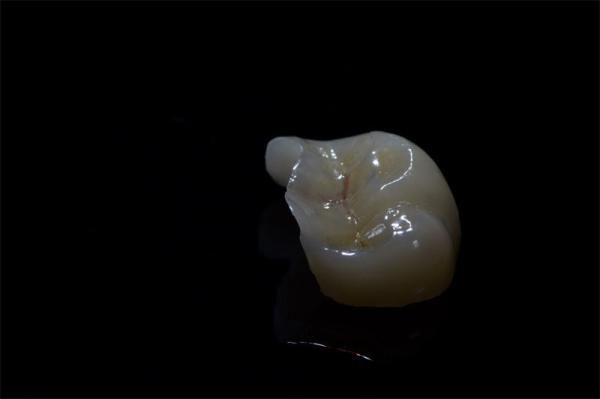 Dental Crown Composite Inlays And Onlays Restoration Customized Shape