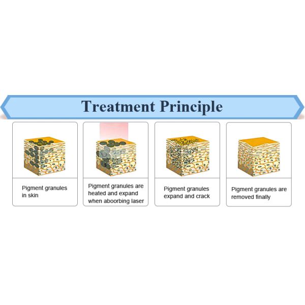 4 - 10mm Honeycomb MLA Tattoo Removing Equipment Q Switched Nd Yag Laser