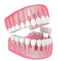 Solo todos los implantes dentales de dientes de cerámica que faltan dentaduras de relleno muelas del juicio