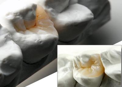 Laboratório Dentário de Aparência Natural Incrustação Cerâmica e Onlay para restauração dental precisa
