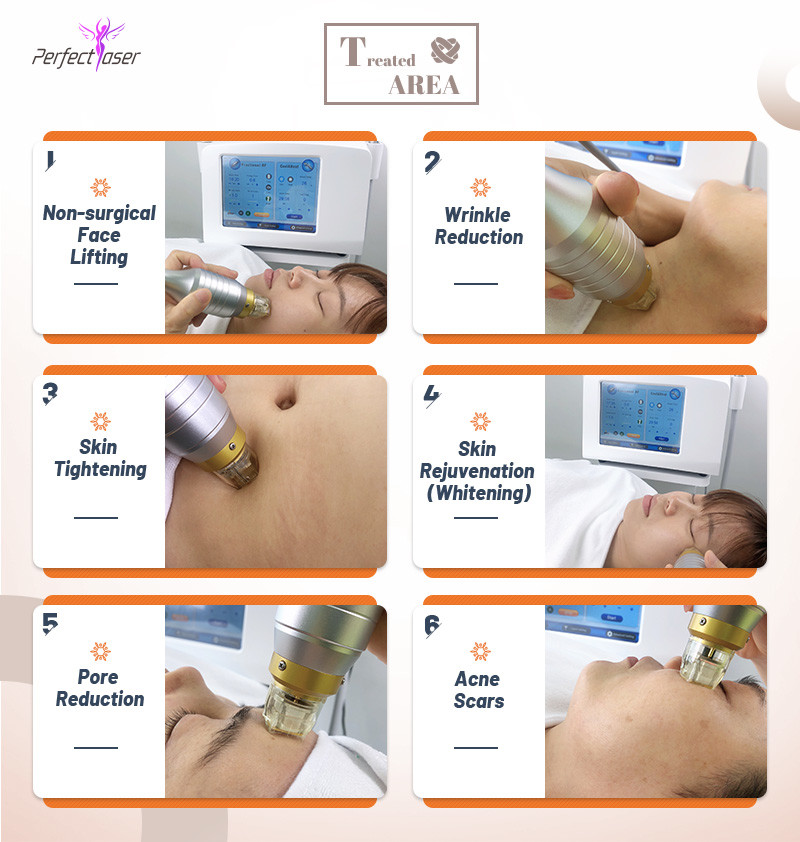 Подтяжка кожи RF Microneedling Machine Машина для удаления растяжек Ance