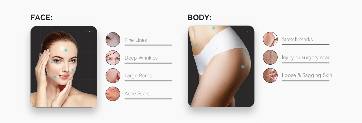 Высококачественная машина Rf Microneedle вакуума Rf Microneedling радиочастоты Microneedling удаления угорь