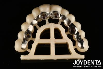 Silver Finish Custom Abutments And Bars Accurate Fit Screw Retained Or Cement Retained