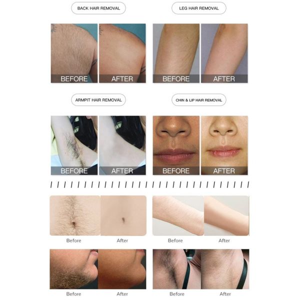 Spa 808 Nm Diode Laser Machine 2 In 1 Hair Removal And Picosecond Tattoo Removal