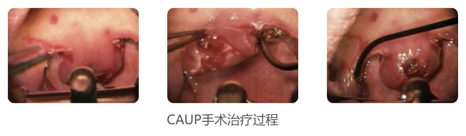 РЧ плазменный хирургический коблатор для тонзилектомии и аденоидектомии