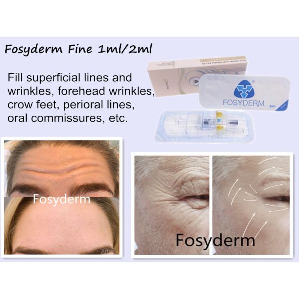 Éliminez l'acide hyaluronique cutané ha réticulé par injection de remplisseur de gel de Fosyderm de ride