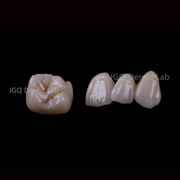 Natural Translucent Zirconia Restorations Custom Designed For Anterior Teeth
