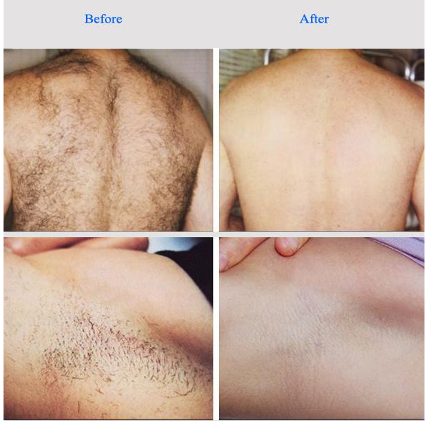 Máquina profesional de depilación con hielo láser, máquina láser de hielo sin dolor.